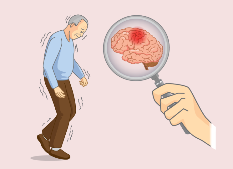 Alzheimer Disease