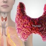 Thyroid