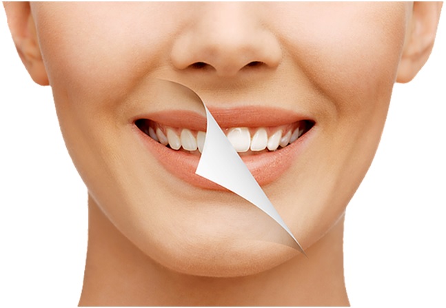 teeth_whitening