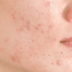 acne scars