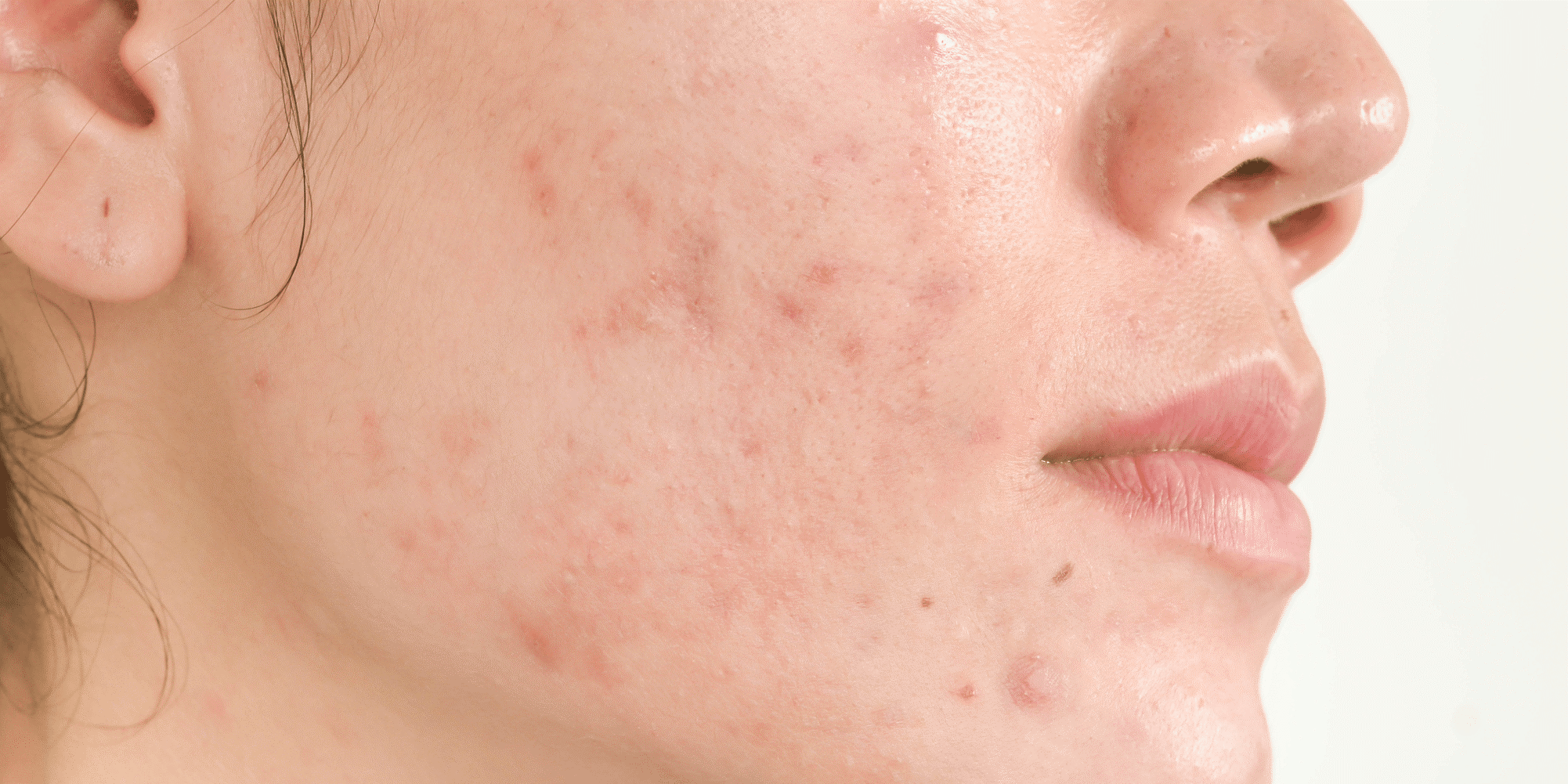 acne scars