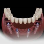 Types of Dentures