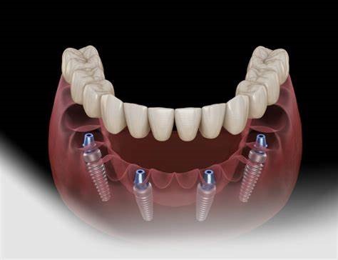 Types of Dentures