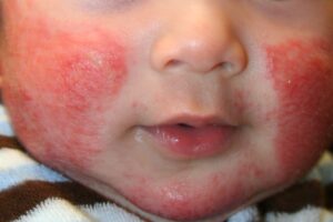 Atopic dermatitis 