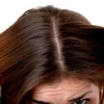 Dandruff vs. Dry Scalp