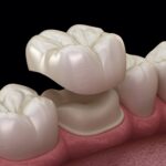 Dental Crowns