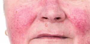 Rosacea