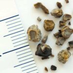 Symptoms and Causes of Kidney Stones (Nephrolithiasis)