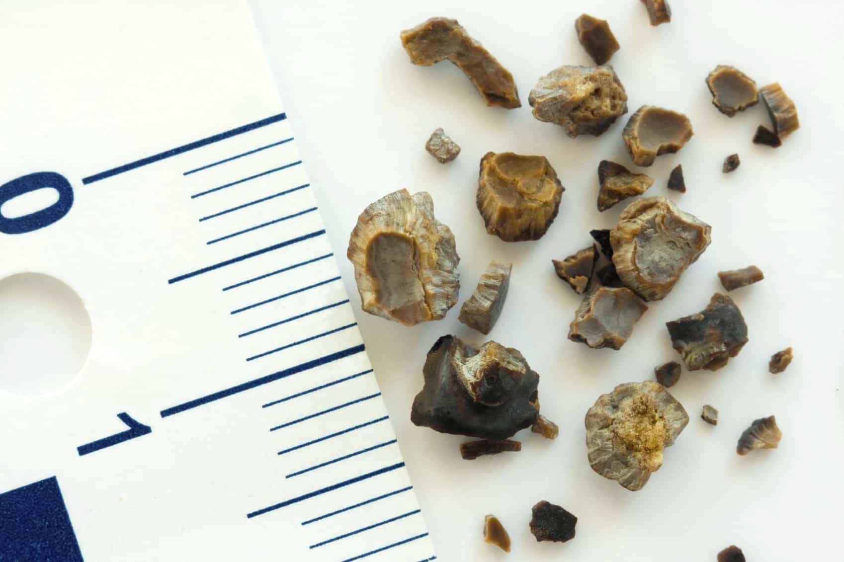 Symptoms and Causes of Kidney Stones (Nephrolithiasis)