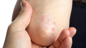 Asks Psoriasis