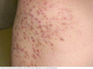 Folliculitis