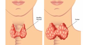 Hypothyroidism