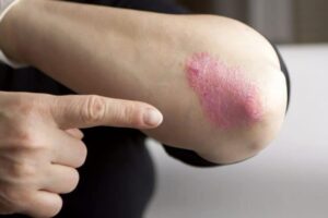 Outbreaks of eczema