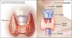 causes of hypothyroidism 