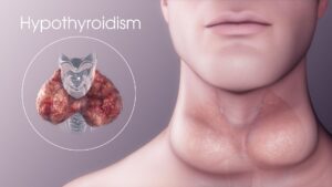 difference between hypothyroidism and hyperthyroidism