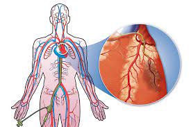 Cardiac catheterization