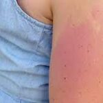 The 10 Most Common Summer Rashes and How to Avoid Them