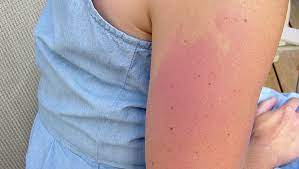 The 10 Most Common Summer Rashes and How to Avoid Them