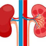 Symptoms and Causes of End-Stage Kidney Disease
