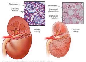 risk for end-stage kidney disease