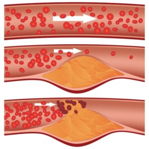 Genetic factors that cause high cholesterol