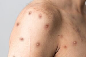 Getting Vaccinated After Exposure to Monkeypox Virus