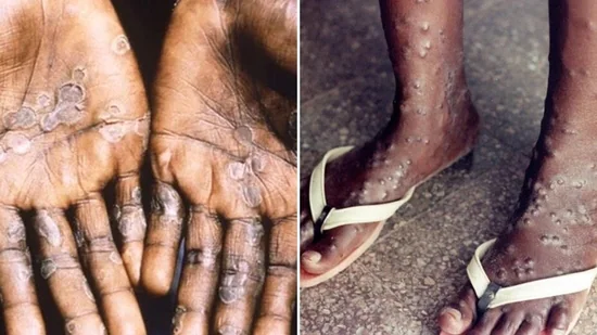 Monkeypox And Smallpox How Are They Different