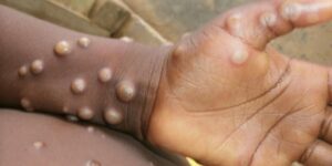 Symptoms of monkey Vs and symptoms of smallpox
