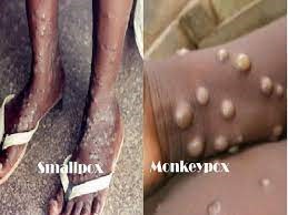 Symptoms of monkey Vs and symptoms of smallpox