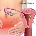 Uterine fibroids - Symptoms, Causes & Treatment