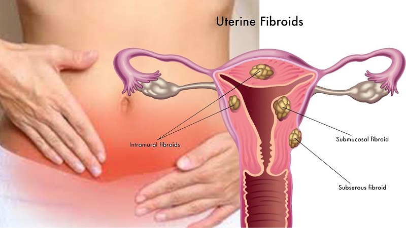 Uterine fibroids - Symptoms, Causes & Treatment