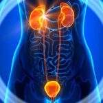 Kidney Stones on the Rise Preventing and Treating a Growing