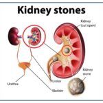 kidney stone