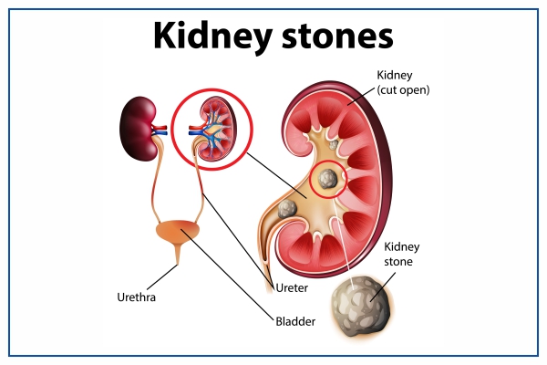 kidney stone