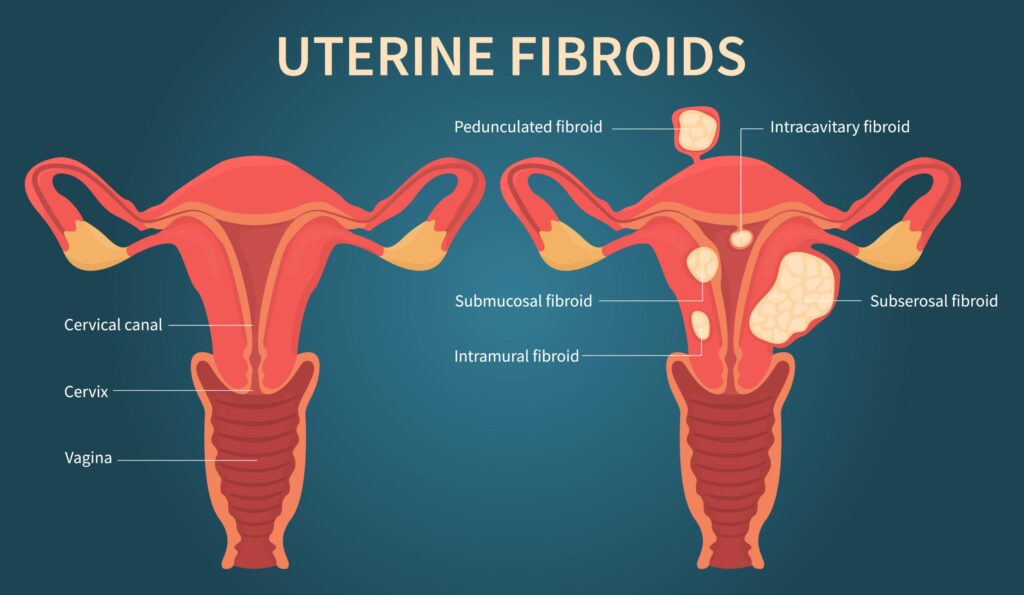 Uterine fibroids - Symptoms, Causes & Treatment