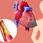 Cholesterol – Symptoms, Causes, and Treatment.