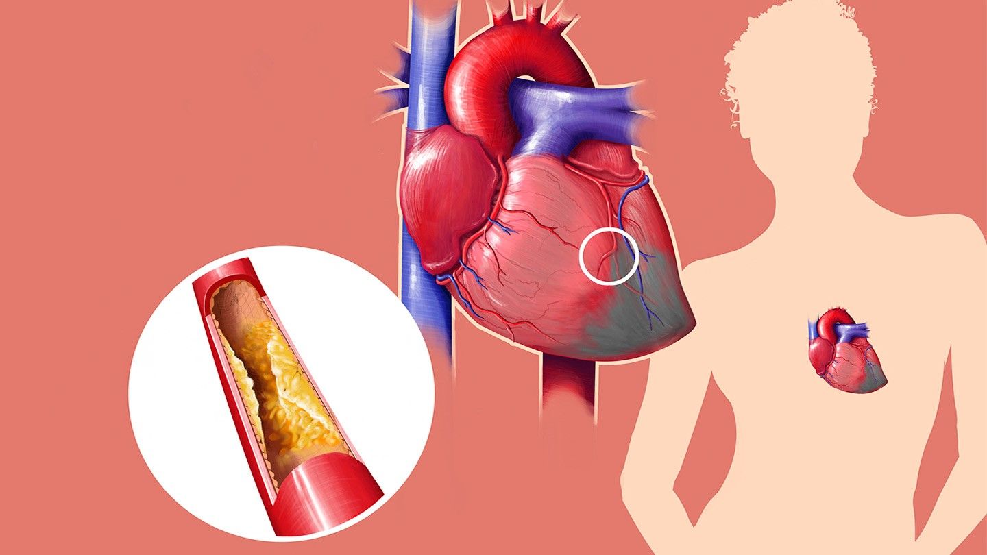 Cholesterol – Symptoms, Causes, and Treatment.