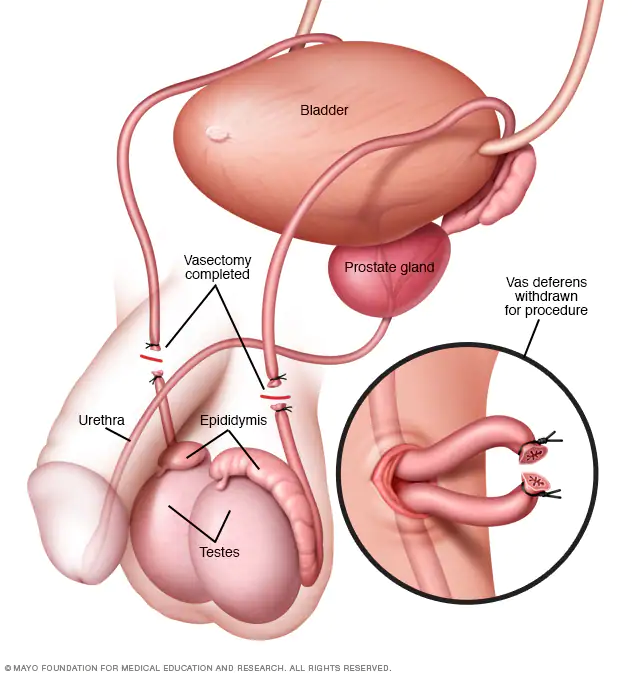 Vasectomies