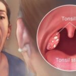 How to get rid of white spots on tonsils