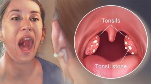 How to get rid of white spots on tonsils