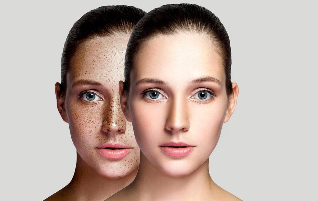 How to get rid of dark spots on face