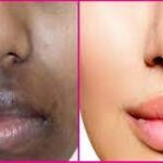How to get rid of black spots on lips