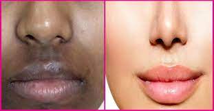 How to get rid of black spots on lips