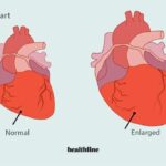 How to Treat an Enlarged Heart: Can Natural Remedies Help?