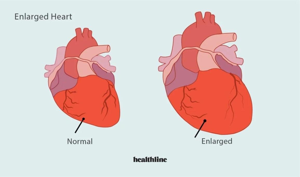 How to Treat an Enlarged Heart: Can Natural Remedies Help?