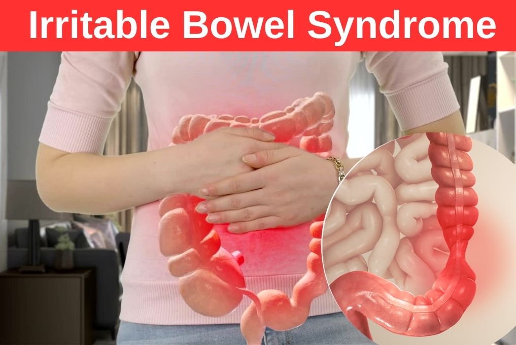 How can irritable bowel syndrome be treated most effectively?