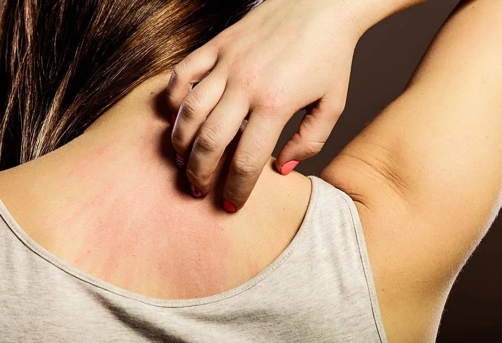 13 Homemade Remedies To Help Relieve Summertime Itching