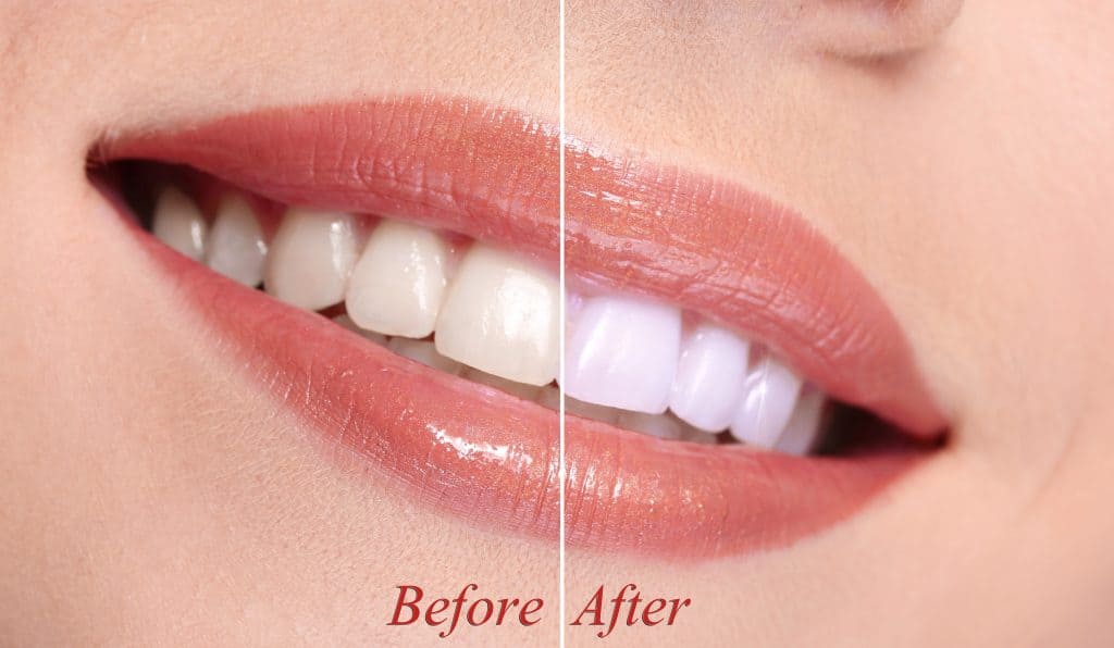 How To Whiten Your Teeth Naturally at Home