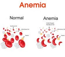anaemia2